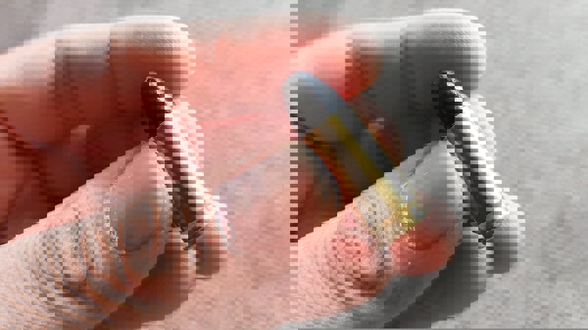 عاش حياته بشكل طبيعي على الرغم من استقرار رصاصة برأسه