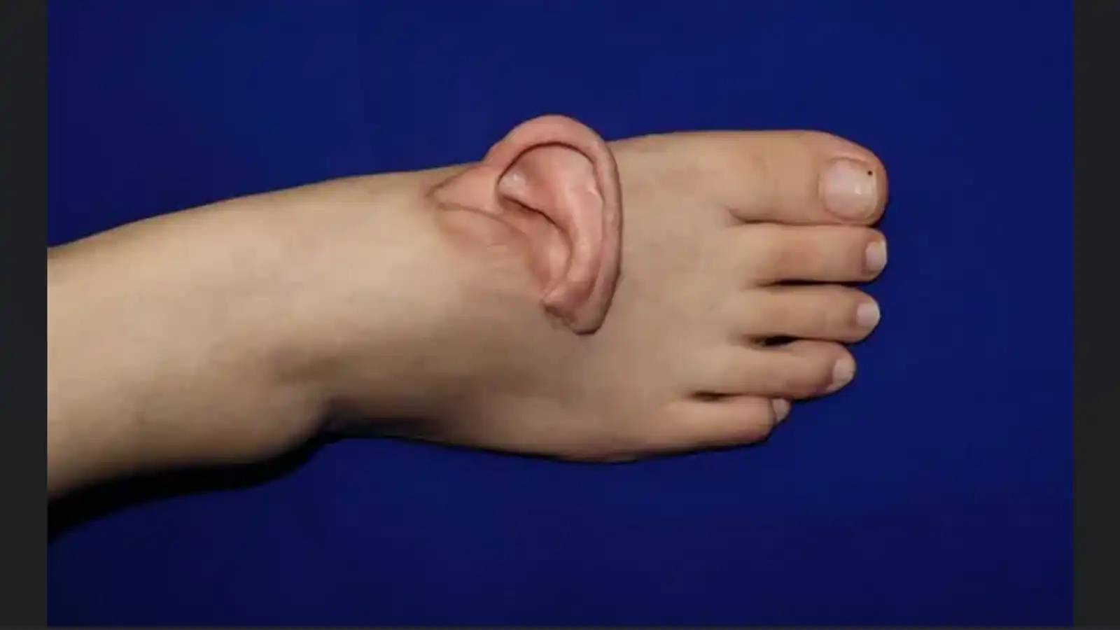 "لأول مرة في التاريخ".. أطباء يزرعون أذناً بشرية على قدم (فيديو)