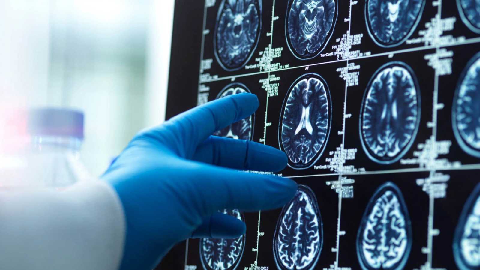 اختبار دم جديد قد يُكشف الزهايمر مبكرًا بدقة أعلى