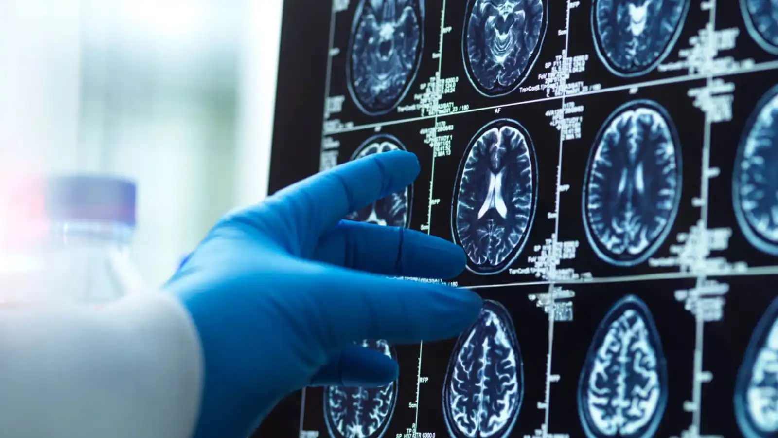 اختبار دم جديد قد يُكشف الزهايمر مبكرًا بدقة أعلى