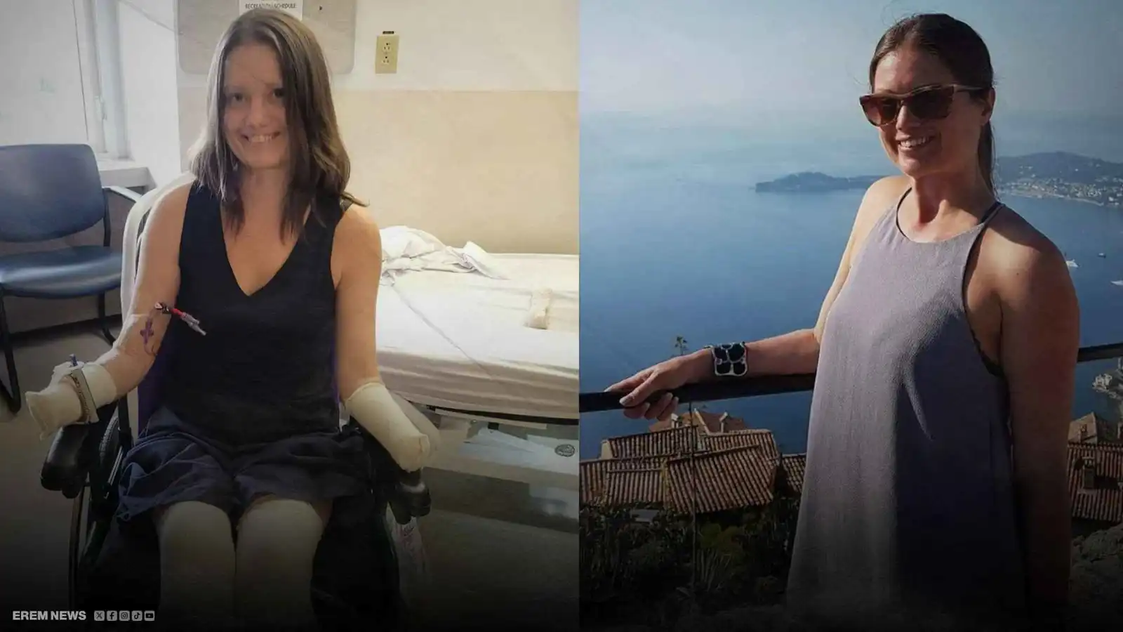 التهاب حلق انتهى ببتر الأطراف.. كندية تعيش كابوسًا صحيًا