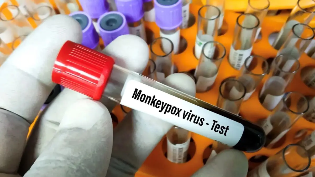 أمريكا تعلن "جدري القرود" حالة طوارئ صحية عامة