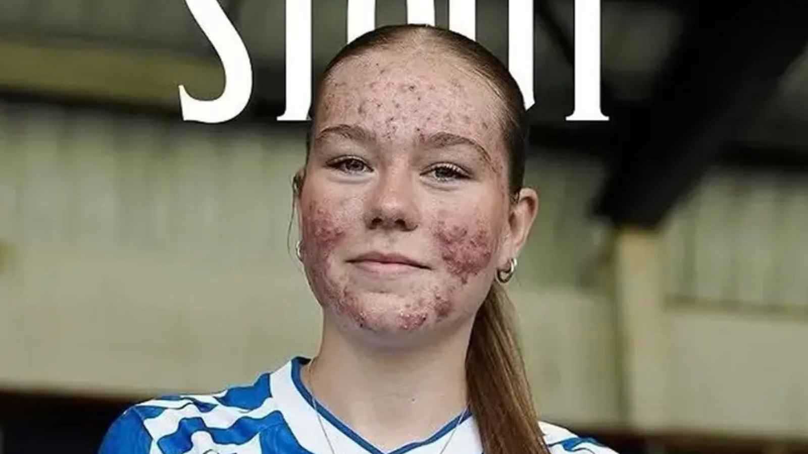 بسبب حب الشباب.. دعم أسطوري ينقذ لاعبة من التنمّر (فيديو إرم)