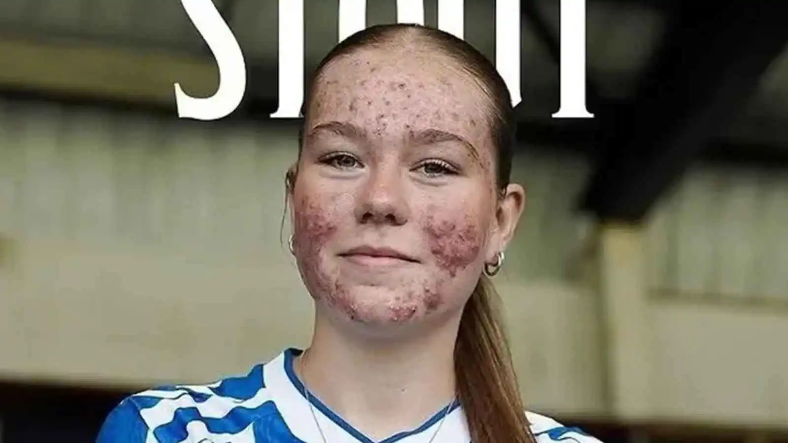 بسبب حب الشباب.. دعم أسطوري ينقذ لاعبة من التنمّر (فيديو إرم)