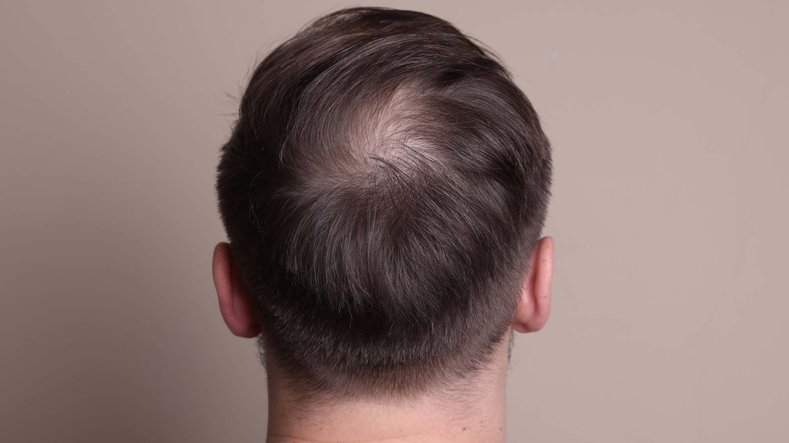 اكتشاف "مفاجئ" لعلاج تساقط الشعر والصلع الوراثي