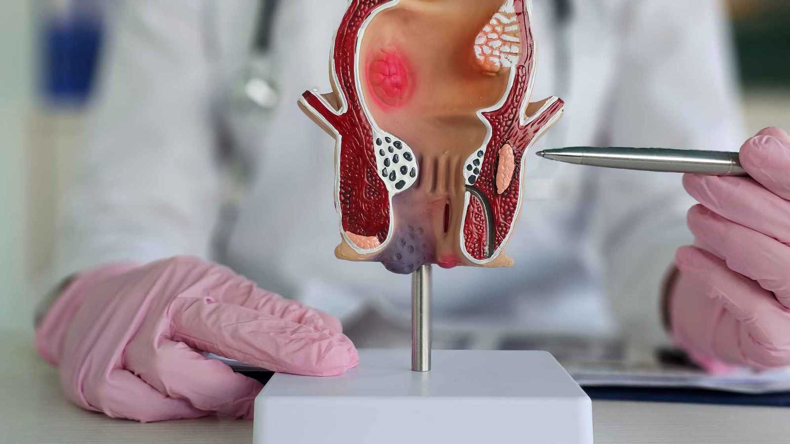 البواسير.. ماذا تعرف عن المرض الذي يعاني منه نصف سكان العالم؟