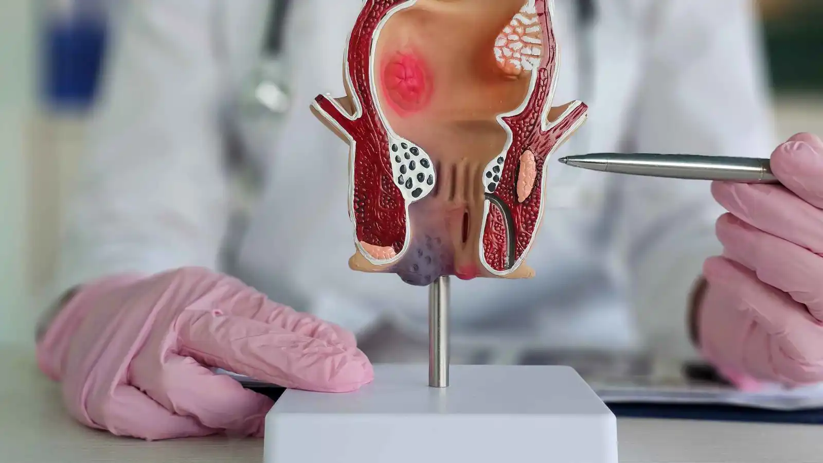 البواسير.. ماذا تعرف عن المرض الذي يعاني منه نصف سكان العالم؟