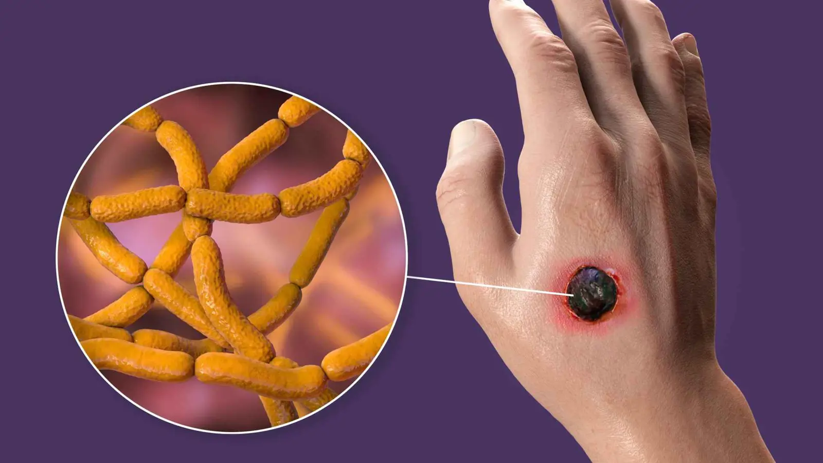 "الجمرة الخبيثة" تعود للواجهة.. وفاة وإصابات تثير قلقاً في الكونغو الديمقراطية