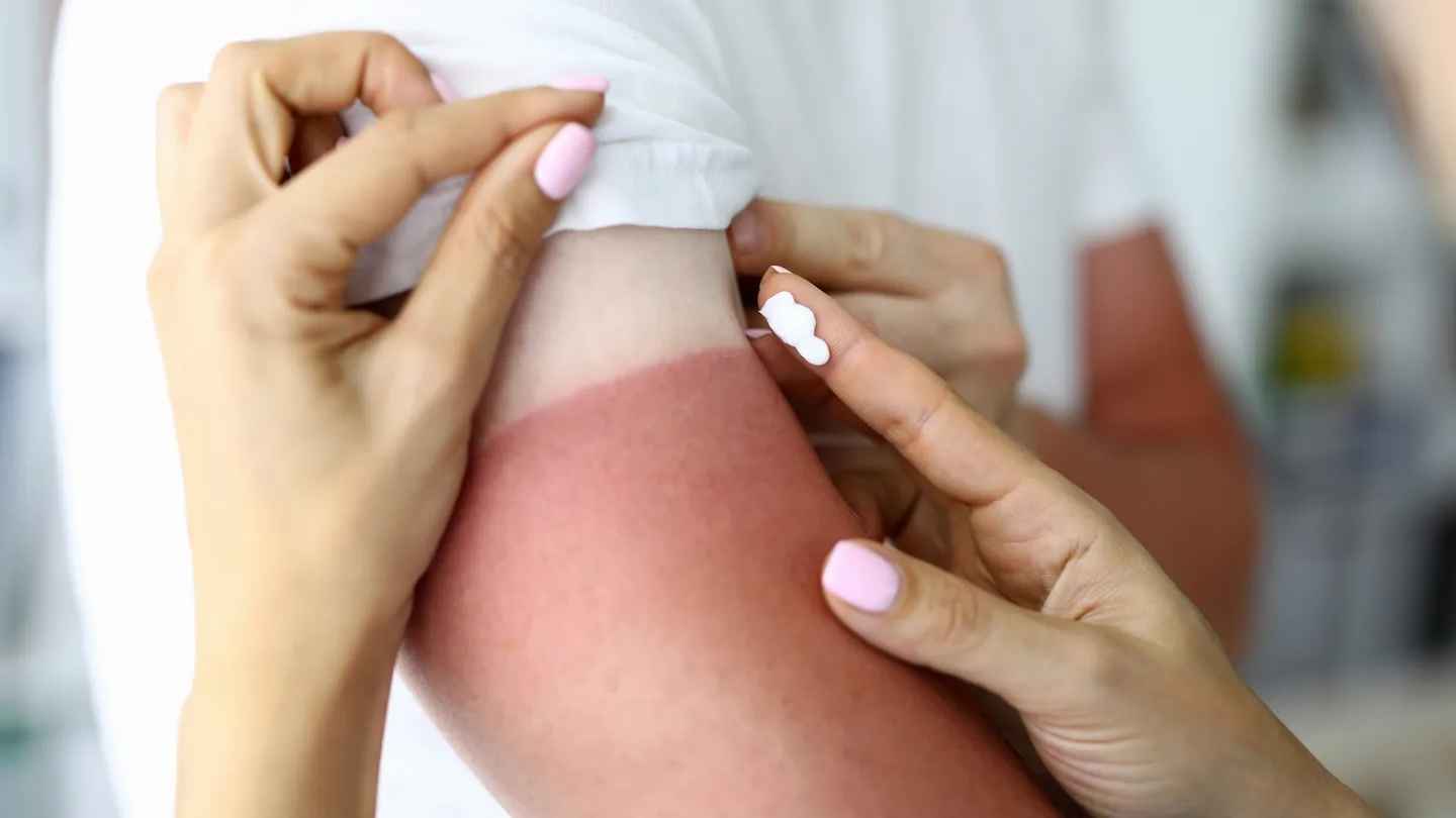 لتضمن التعافي سريعاً.. تجنّب هذه الأخطاء بعد حروق الشمس