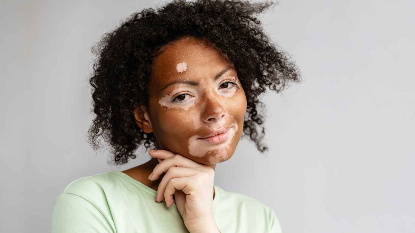 في يومه العالمي.. تعرّف على الخرافات الشائعة عن "البهاق"