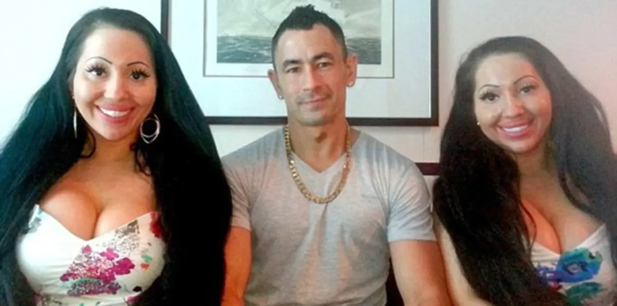 توأم يتفق على تقاسم قلب رجل واحد