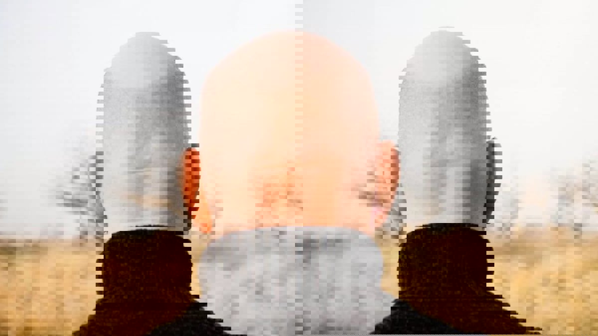 الحياة العصرية ترفع معدلات الصلع لدى الشباب