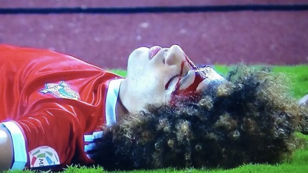 إصابة علي النمر لاعب الوحدة بـ3 كسور في الوجه وكسر بإحدى أسنانه