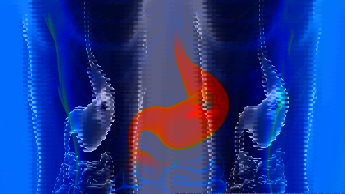 ما الجديد في علاج القرحة الهضمية؟