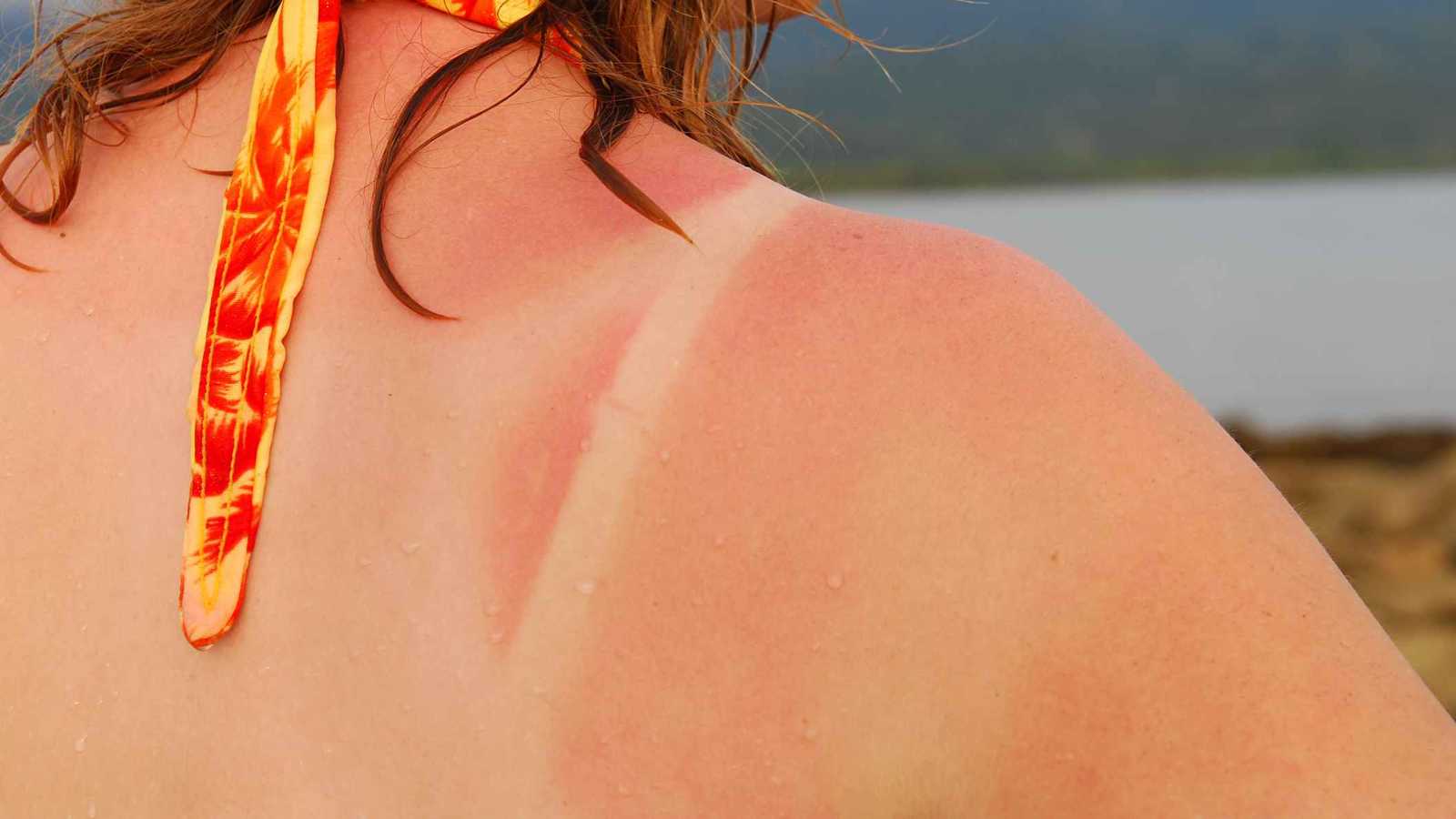 "خطوط الحروق".. تحذيرات من ترند خطير على تيك توك