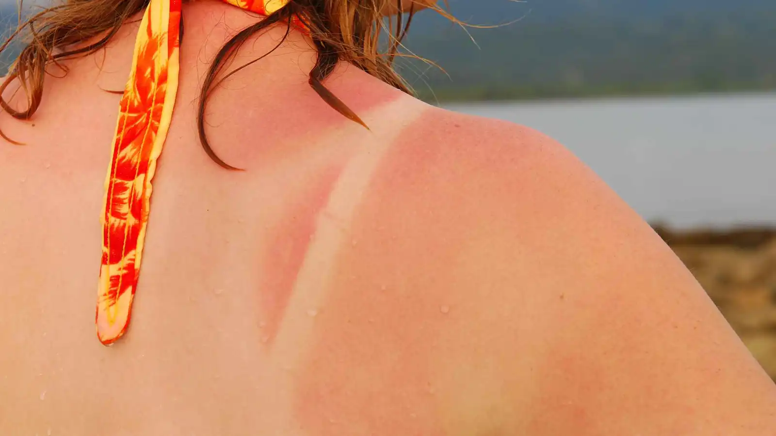 "خطوط الحروق".. تحذيرات من ترند خطير على تيك توك