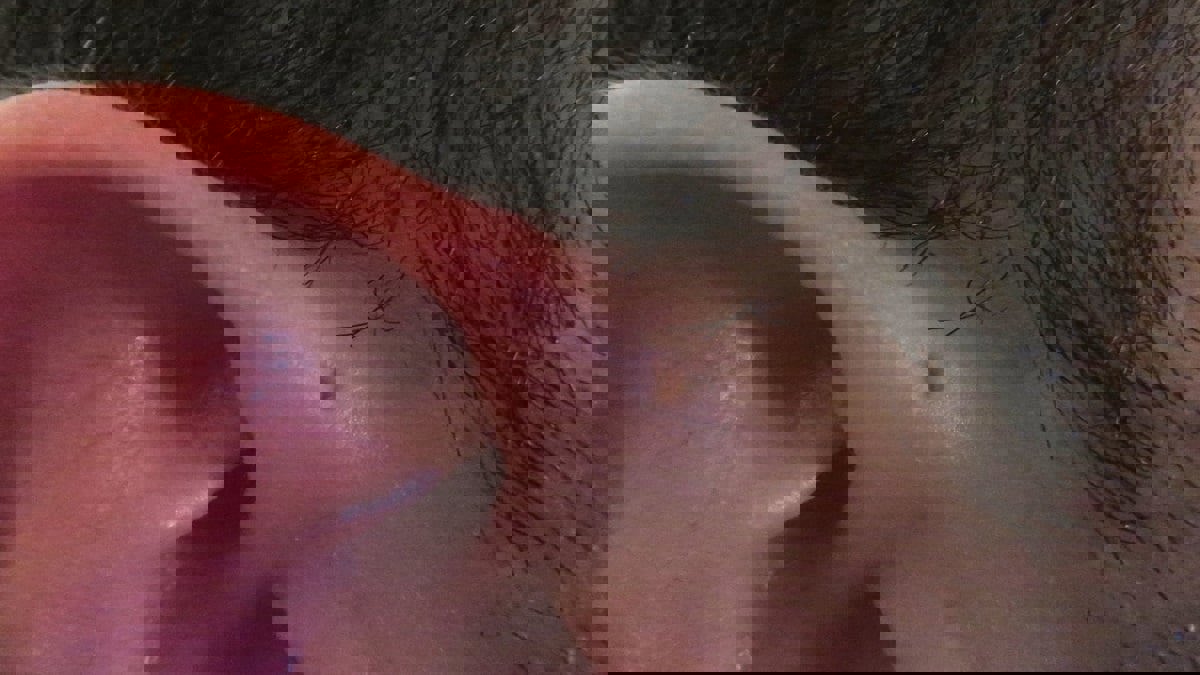 ابتكار تقنية جديدة قد تقود لعلاج تشوهات الأذن‎‎