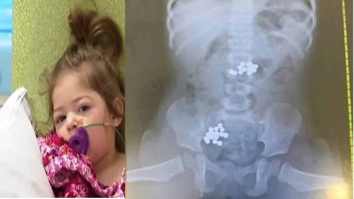 رضيعة تنجو من الموت بأعجوبة بعد ابتلاعها 32 كرة مغناطيسية