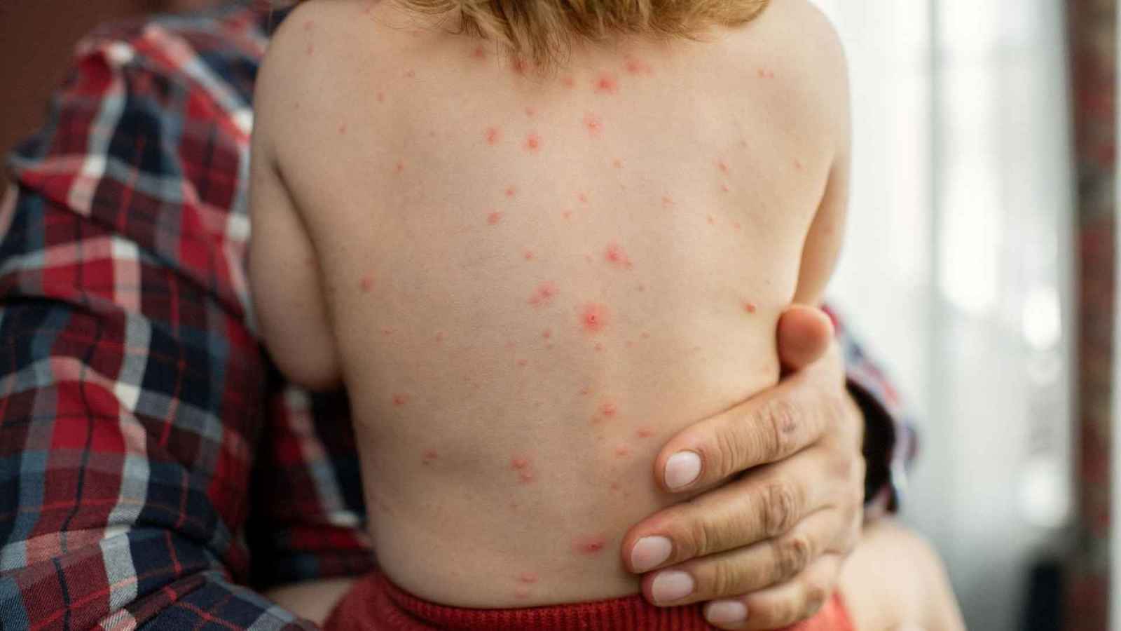 المغرب.. ارتفاع الإصابات بحصبة "بوحمرون" يدق ناقوس الخطر