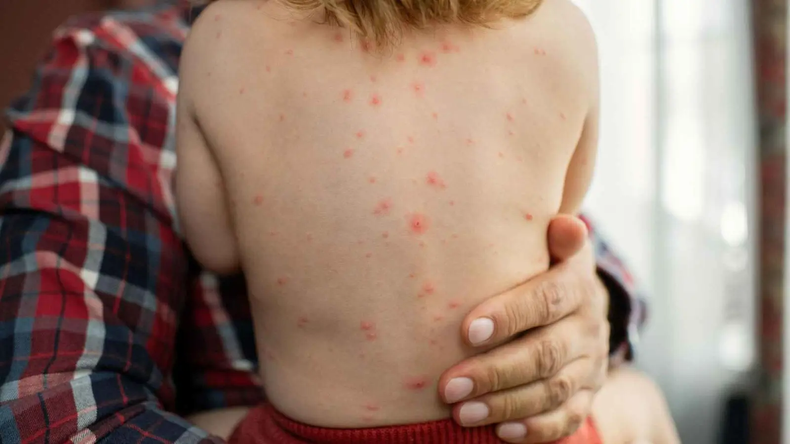 المغرب.. ارتفاع الإصابات بحصبة "بوحمرون" يدق ناقوس الخطر