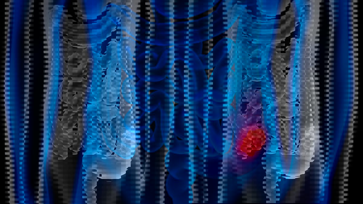 دراسة: الأطعمة المصنعة والسريعة تزيد خطر الإصابة بسرطان الأمعاء