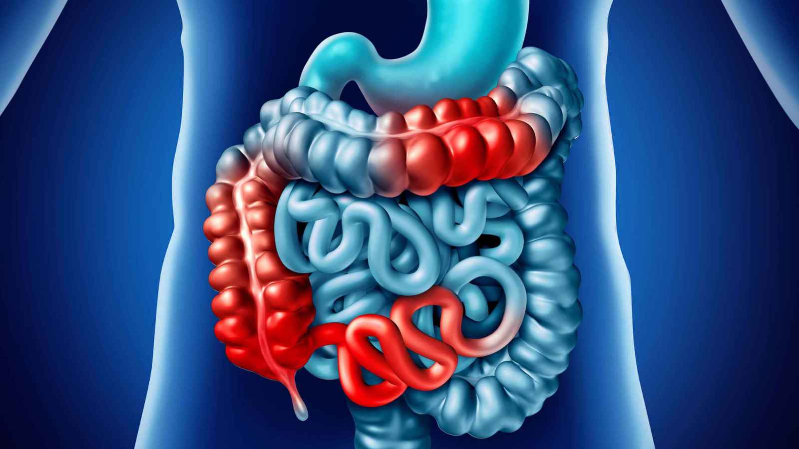 بعض أعراضه خفية.. خطوات لتفادي مضاعفات مرض "كرون"