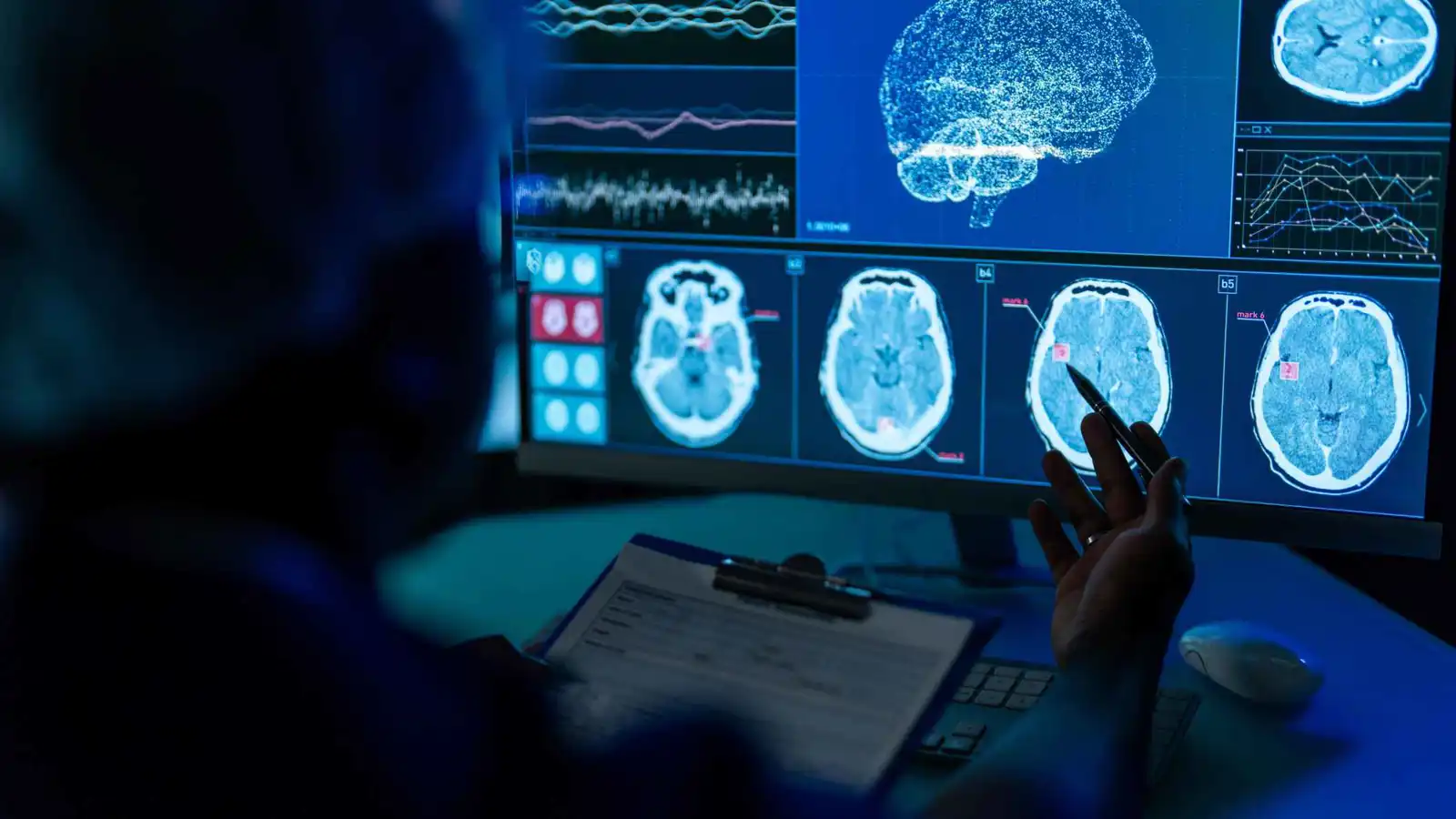 تقنية مغناطيسية جديدة قد تقلل خطر السكتة الدماغية