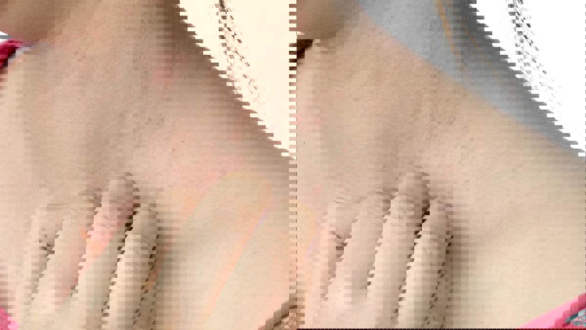 دراسة.. علماء يصلون لمنشأ الإكزيما 