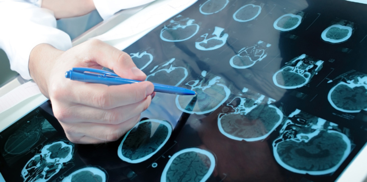 اكتشاف علاقة مثيرة للدهشة بين مستوى السكر في الدم وأورام الدماغ