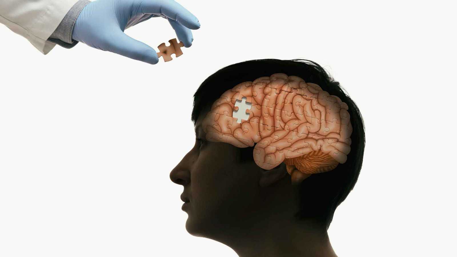 فقدان الكوليسترول من الدماغ قد يكون أول شرارة للزهايمر