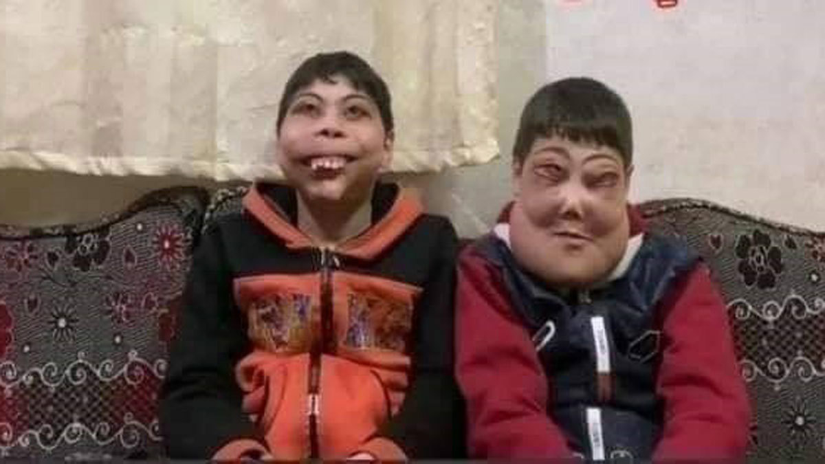 طفلان يعانيان من مرض نادر يثيران تعاطف المصريين (صور)