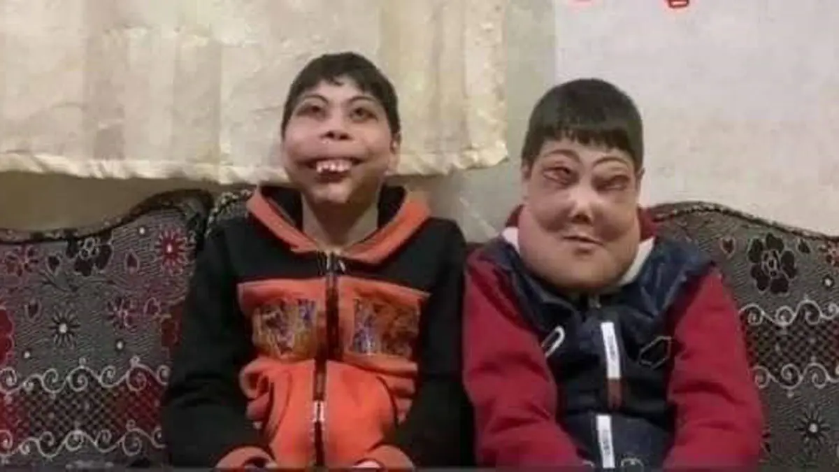 طفلان يعانيان من مرض نادر يثيران تعاطف المصريين (صور)