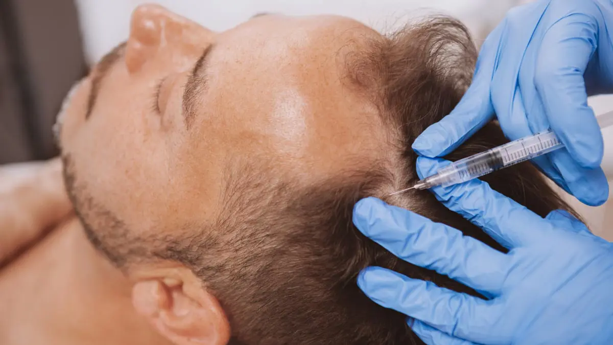 حقن دهون الفخدين في فروة الرأس يمنع الصلع