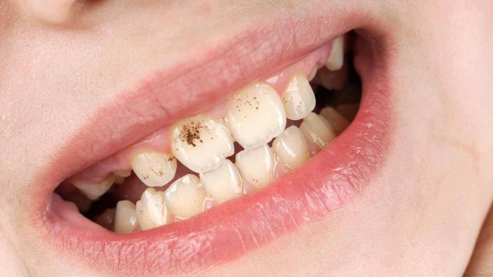 كيف تكشف بقع الأسنان عن تحذيرات صحية مبكرة؟