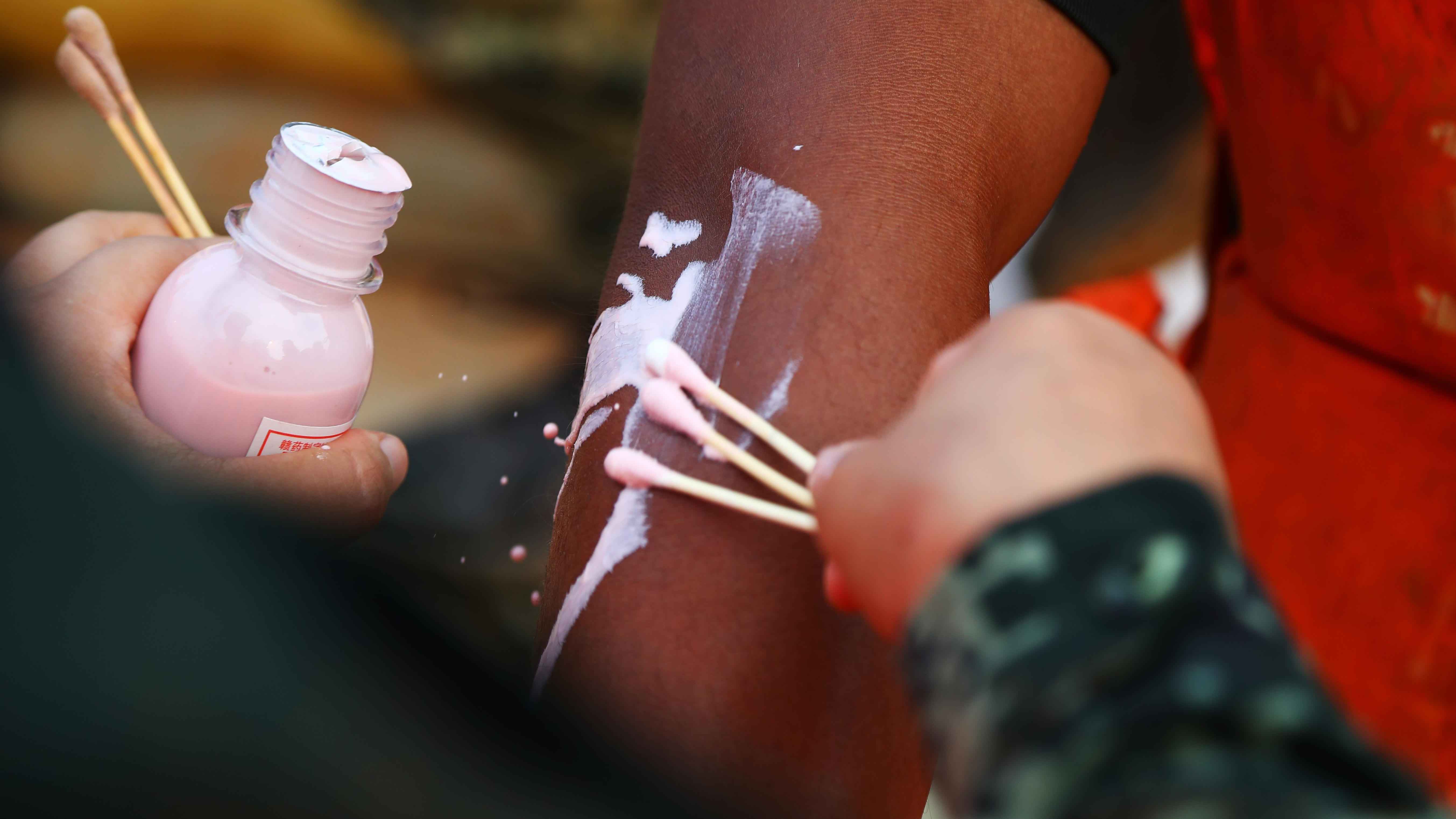 كيف تعرف أنّ حروق الشمس تحتاج لرعاية طبية‎؟