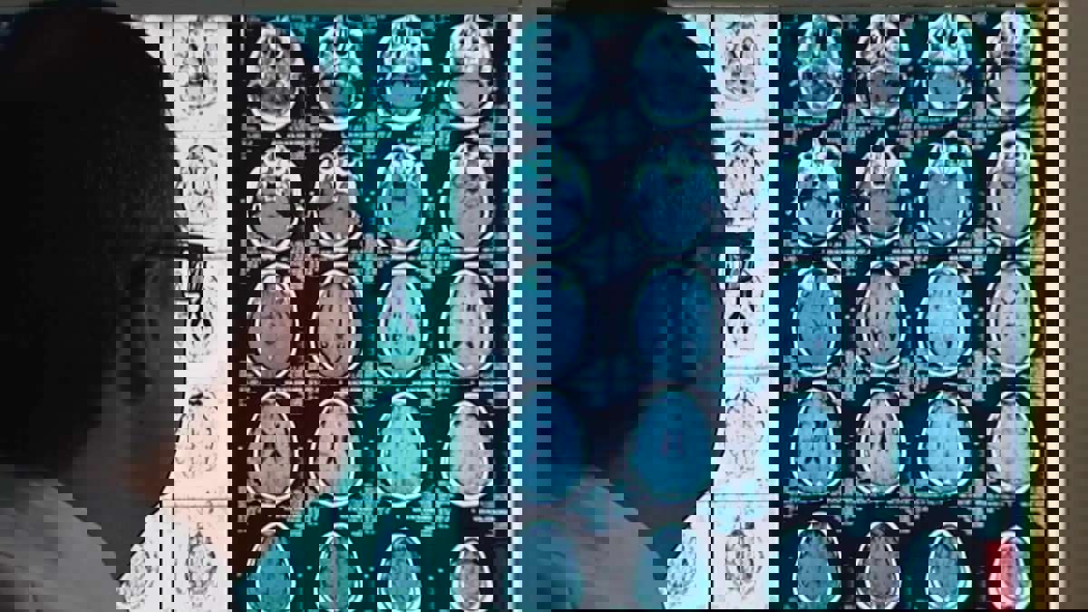 الكشف عن مناطق الدماغ المرتبطة بجنون الارتياب