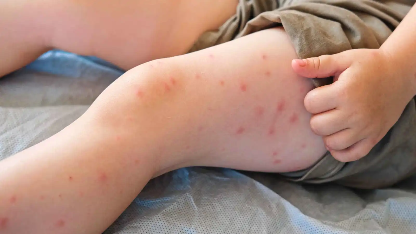 مسؤول صحي: الحصبة تهدد الولايات المتحدة واللقاح ضرورة قصوى