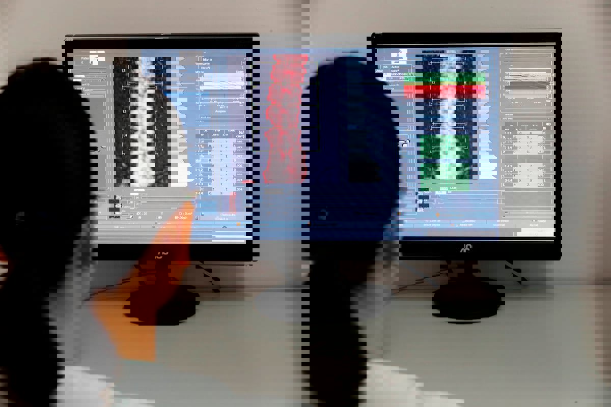 اختبار بالذكاء الاصطناعي قد يكشف هشاشة العظام قبل 8 سنوات من الإصابة 