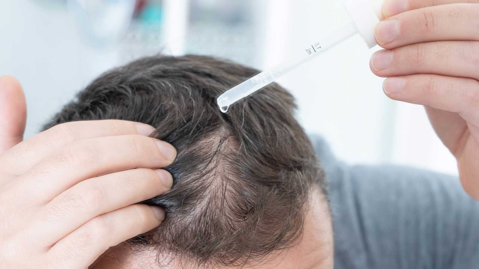 هل تؤثر أدوية تساقط الشعر على خصوبة الرجال؟