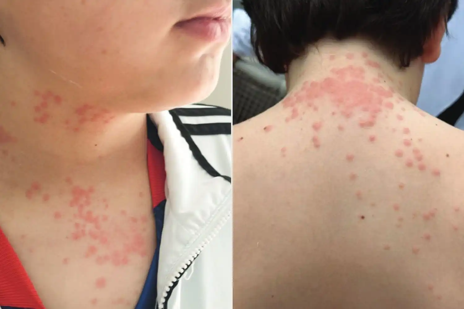 تقول العائلة إنهم تعرضوا للدغات بق الفراش أثناء رحلتهم الجوية.