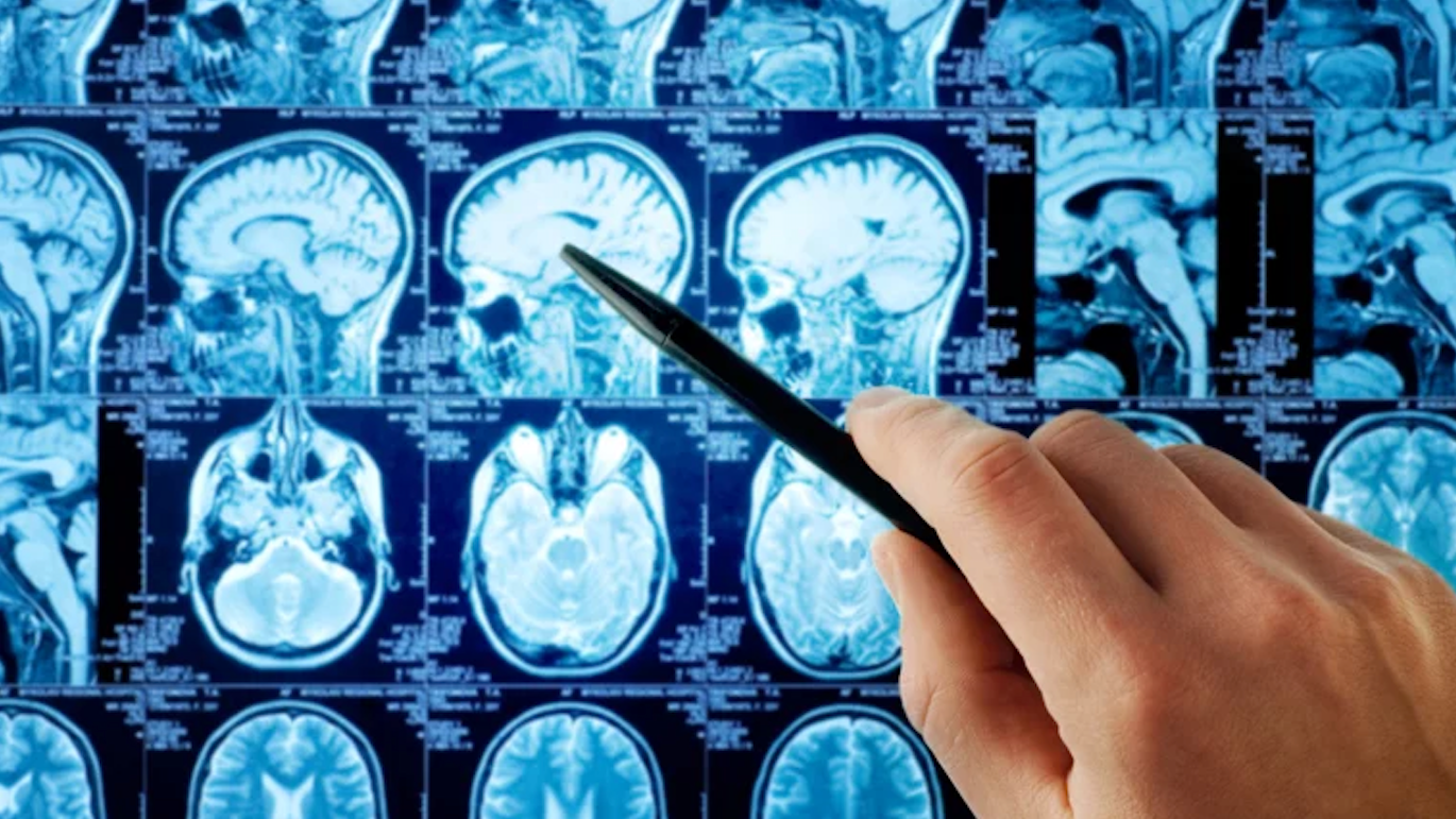 أمل طبي جديد لمرضى السرطان الدماغي العدواني