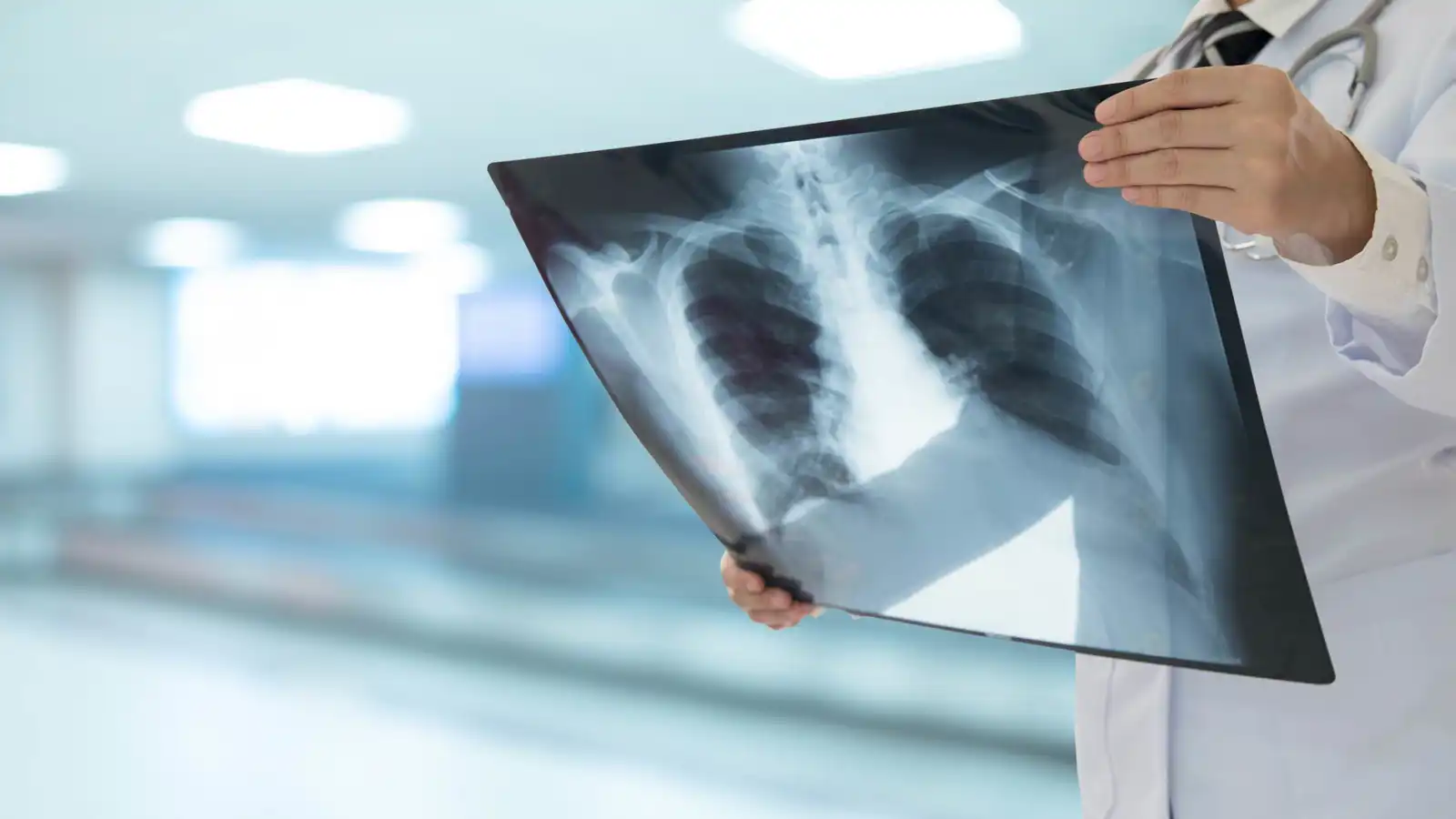 تحذير لمتعافي "كوفيد-19" من زيادة خطر الإصابة بسرطان الرئة