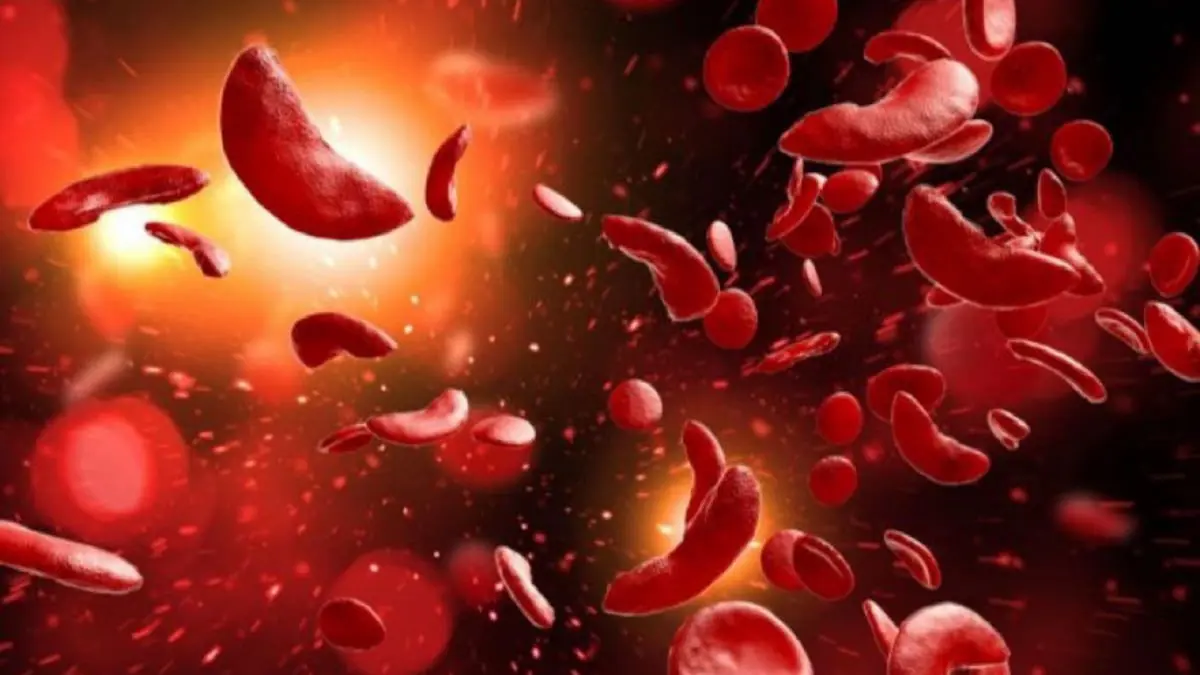 إجازة استخدام أول علاج بمقص "كريسبر" لمرضى "فقر الدم المنجلي"
