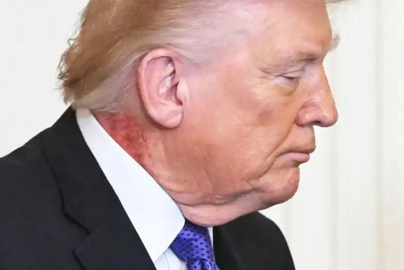 ظهر الرئيس دونالد ترامب مصاباً بطفح جلدي كبير في رقبته