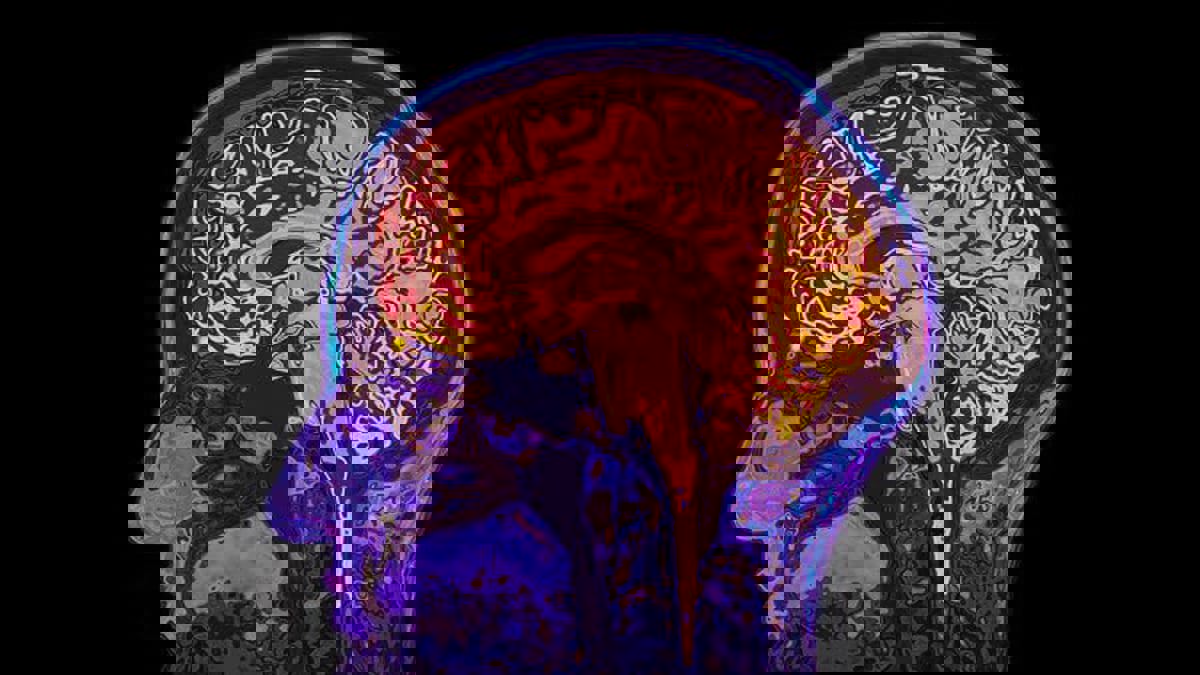 "نوبة صرع" تجعل بريطانيًا يتحدث الفرنسية 
