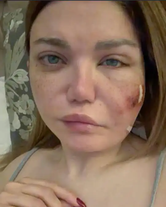 إصابة ياسمين الخطيب بعدوى بكتيرية فى الأنسجة