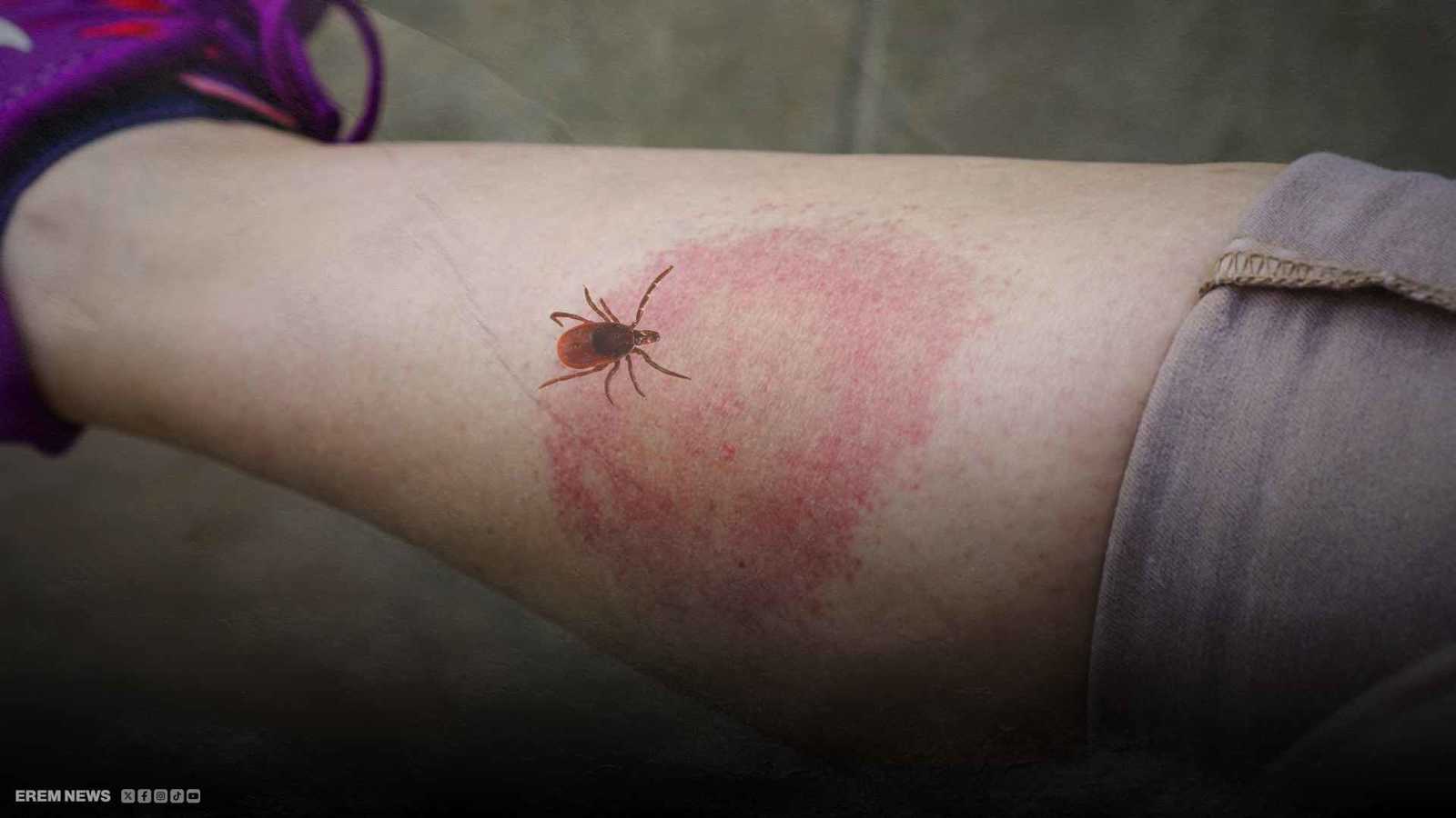 آخرهم تيمبرليك.. ماذا تعرف عن "مرض القراد" الذي يصيب المشاهير؟