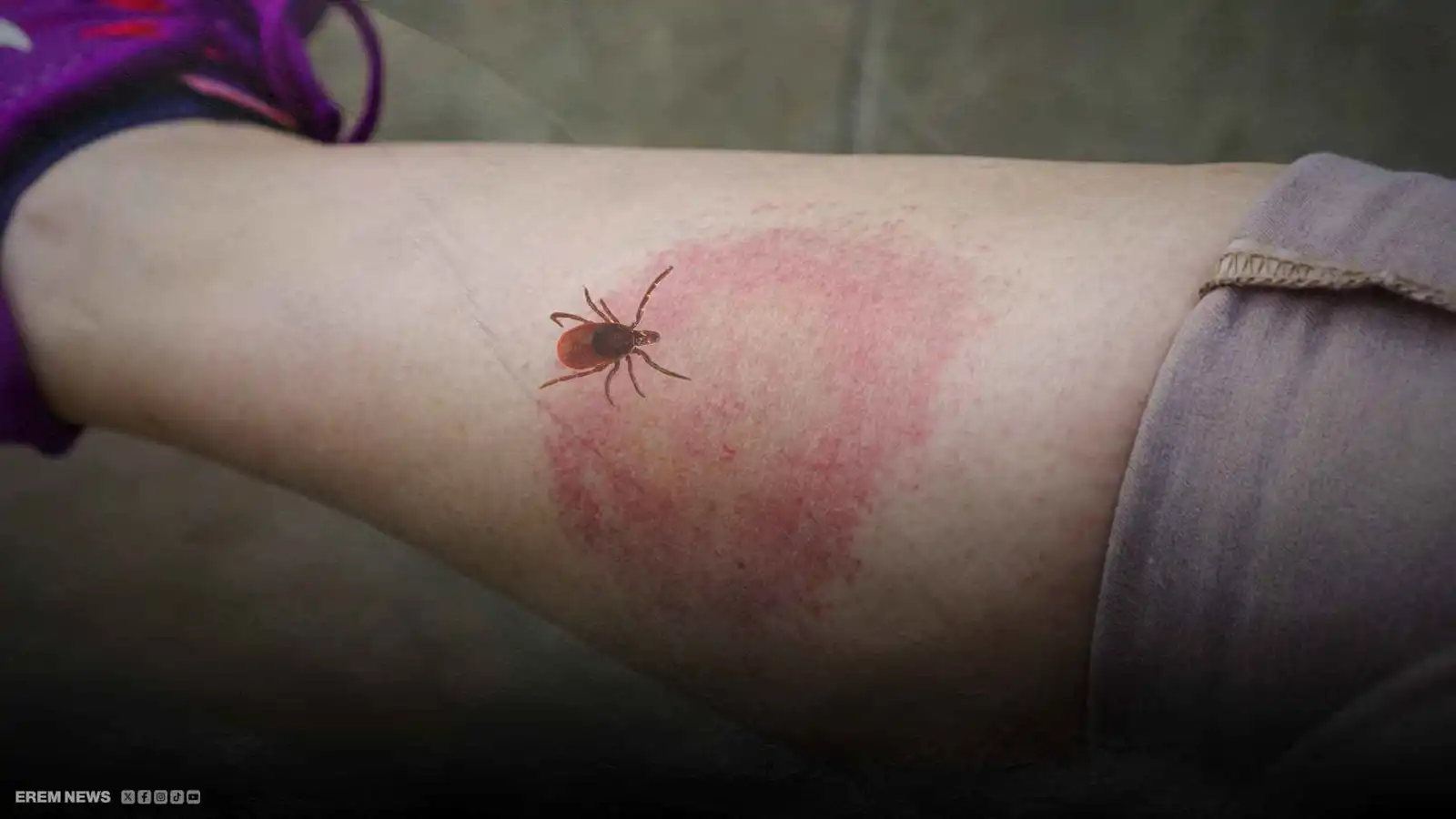 آخرهم تيمبرليك.. ماذا تعرف عن "مرض القراد" الذي يصيب المشاهير؟