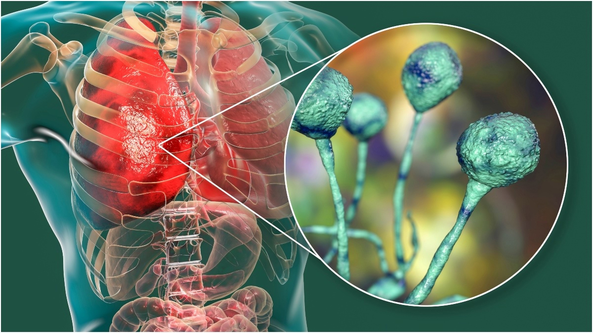 مسؤول مصري يؤكد ظهور إصابات بالفطر الأسود ويحذر