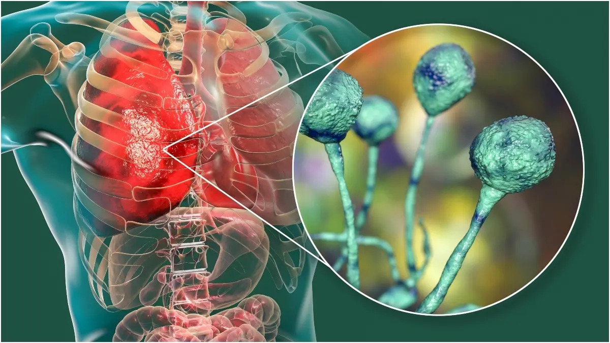 مسؤول مصري يؤكد ظهور إصابات بالفطر الأسود ويحذر